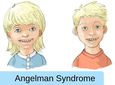 15η Φεβρουαρίου: Παγκόσμια Ημέρα για το Σύνδρομο Angelman