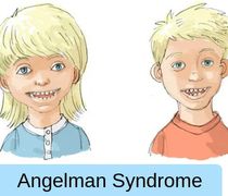 15η Φεβρουαρίου: Παγκόσμια Ημέρα για το Σύνδρομο Angelman