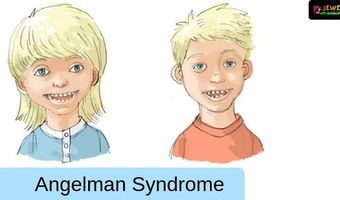 15η Φεβρουαρίου: Παγκόσμια Ημέρα για το Σύνδρομο Angelman