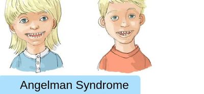 15η Φεβρουαρίου: Παγκόσμια Ημέρα για το Σύνδρομο Angelman