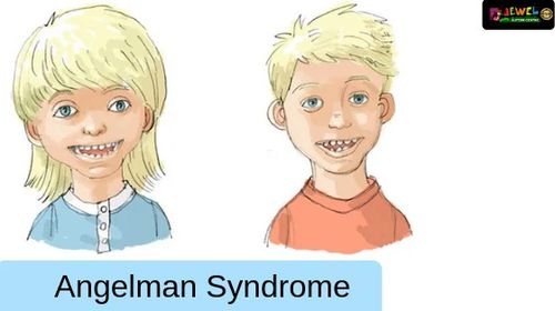 15η Φεβρουαρίου: Παγκόσμια Ημέρα για το Σύνδρομο Angelman